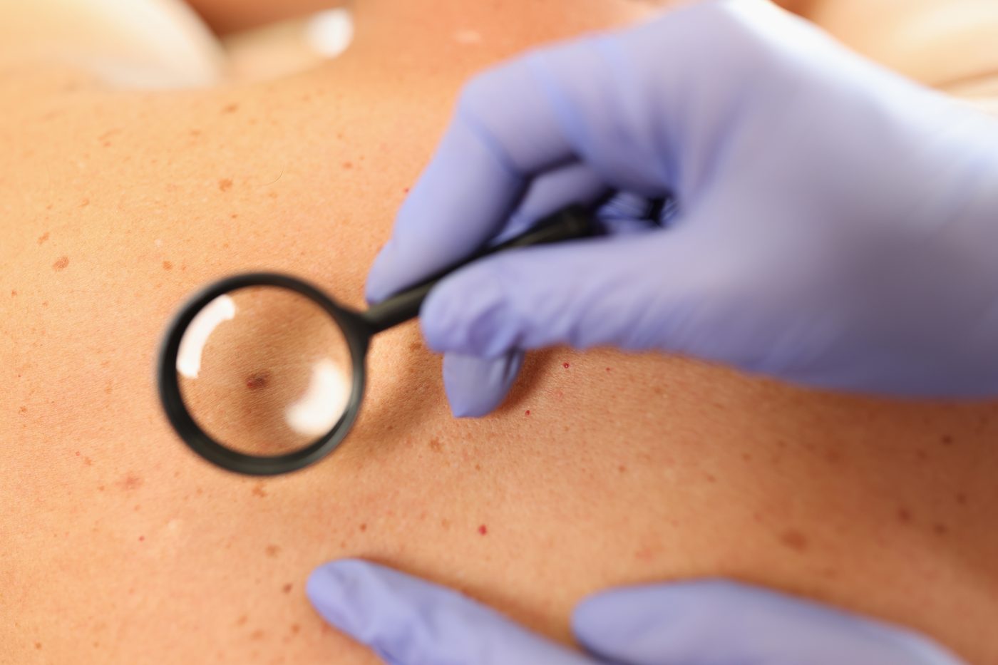 How Often Should You Have a Skin Cancer Check? An Australian Guide