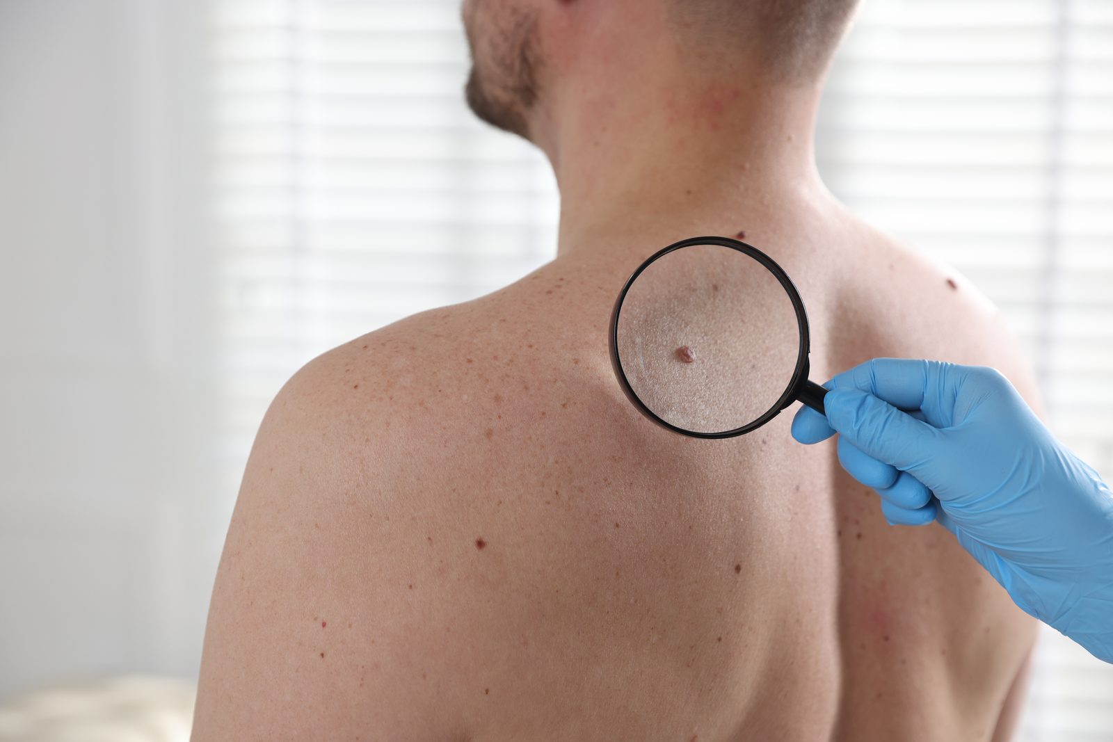 Skin Cancer Checks and Minor Procedures at Toongabbie Doctors